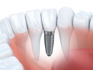 Dental Implants Vista, CA